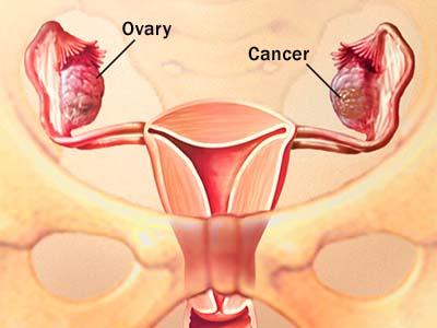 卵巢癌照片