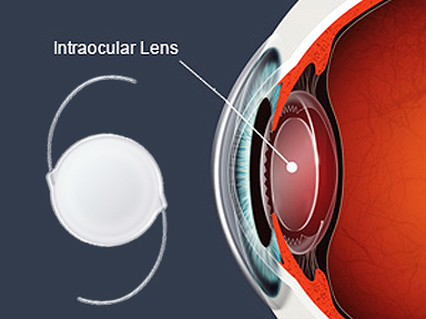 intraocular_lens9-29