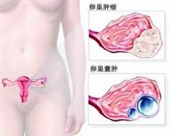 01-21-17卵巢癌照片